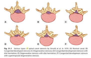 腰部脊柱管狭窄症(Lumbar Spinal Stenosis)