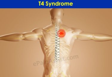第4胸椎(T4)症候群